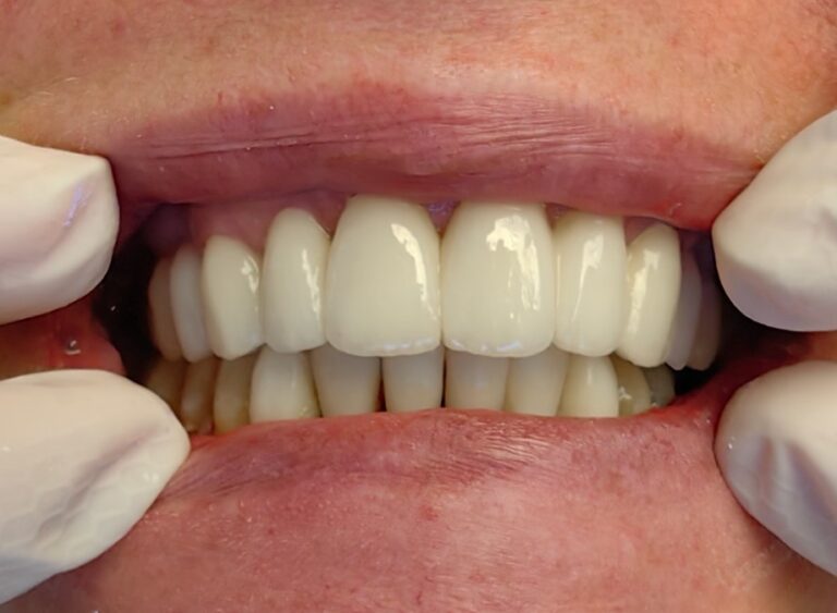 Częściowe braki w szczęce i żuchwie - po