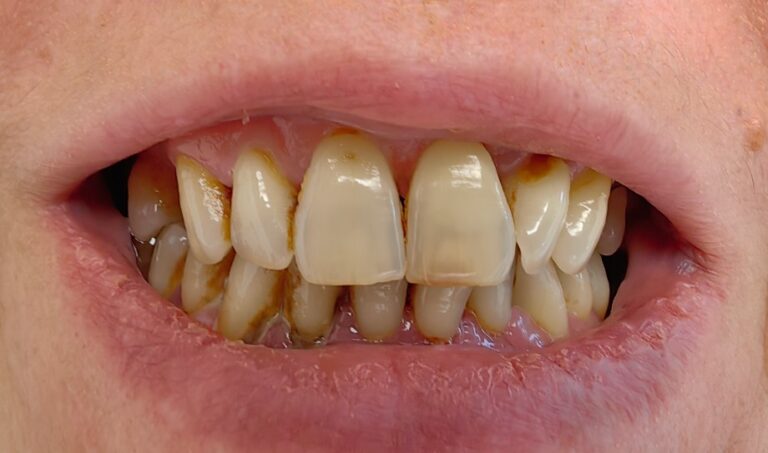 Częściowe braki w szczęce i żuchwie - przed