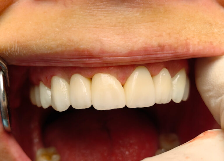 Odbudowa estetyki uśmiechu - po