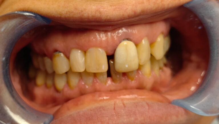 Odbudowa estetyki uśmiechu - przed