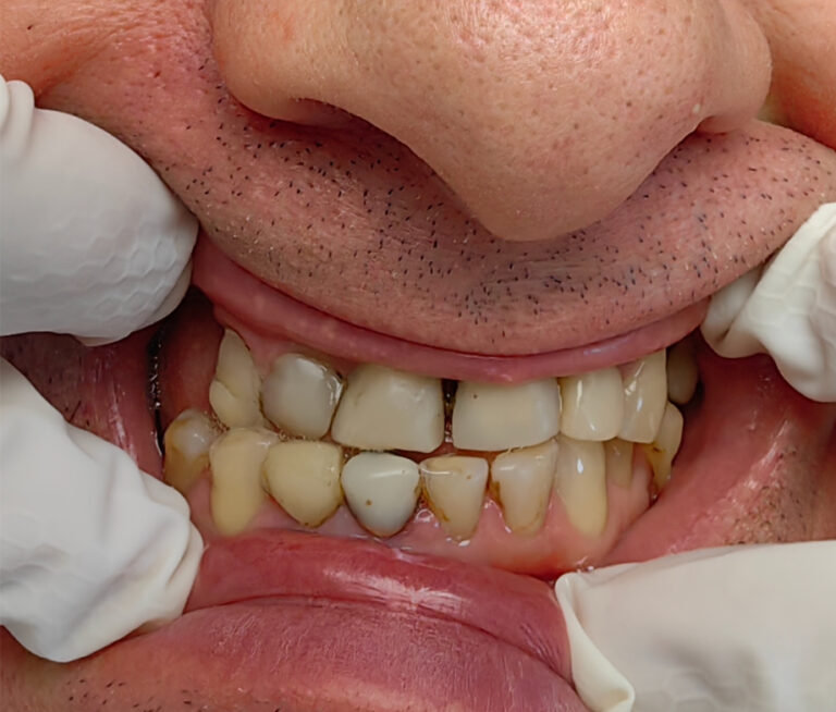 Częściowe braki w szczęce i żuchwie - przed