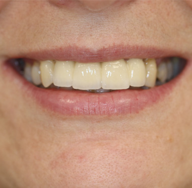 Odbudowa 12-22 na implantach - po