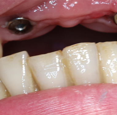 Odbudowa 12-22 na implantach - przed