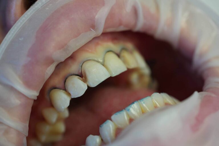 Enamel - przed
